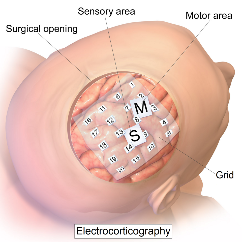 Medical illustration of an electrode grid placed on the exposed surface of the brain.